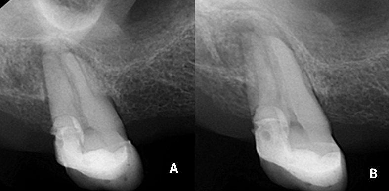 Figura 1. (A) Radiografía periapical inicial céntrica. Se observa compromiso periapical en relación con seno maxilar. (B) Radiografía periapical con deslizamiento distal.