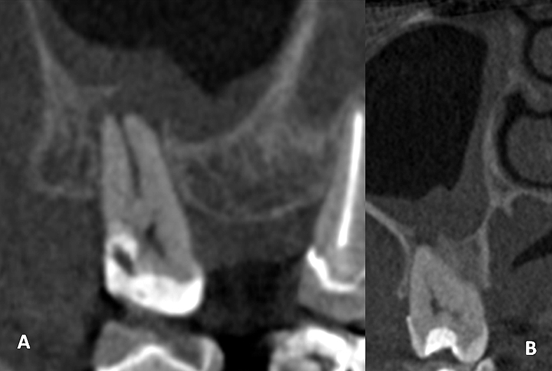Figura 2. (A) Corte coronal de CBCT. Se observa mucosa del seno maxilar engrosada y comunicación con raíz mesiovestibular de diente 1.7. (B) Corte sagital de CBCT. Se observa conexión entre raíz mesiovestibular y seno maxilar.