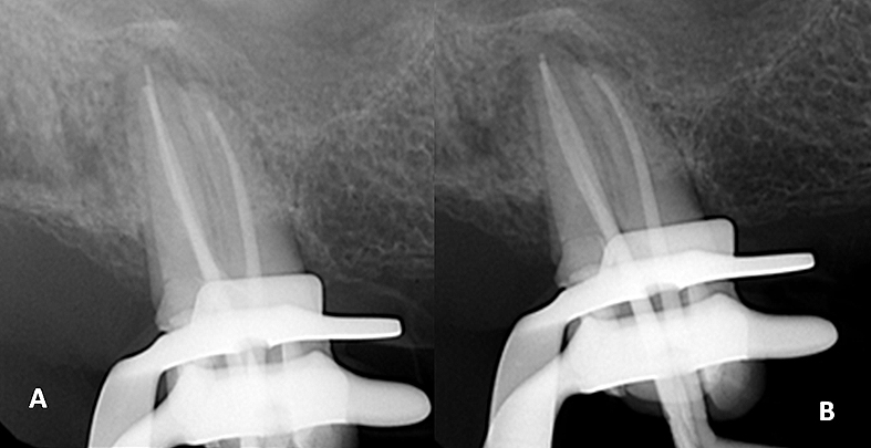 Figura 3. (A) Radiografía periapical céntrica de conometría. (B) Radiografía periapical de conometría con deslizamiento mesial.