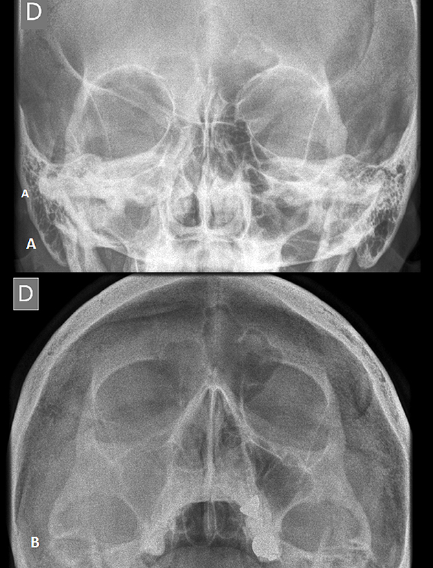 Figura 4. (A) Radiografía Caldwell de senos paranasales. (B) Radiografía Waters. Se observa velamiento de seno maxilar derecho