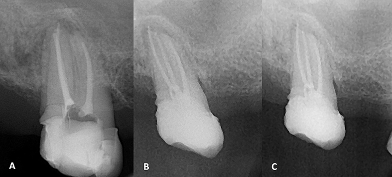 Figura 6. (A). Radiografía periapical de control. (B) Radiografía periapical de control a los 2 meses.(C) Radiografía periapical de control a los 2 meses con deslizamiento mesial.