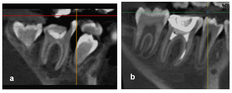  Figura 11. Comparación tomográfica en corte sagital: a) inicio del tratamiento (presencia de lesión periapical), b) 1 año posterior al tratamiento (resolución de la lesión periapical).