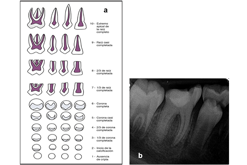 Figura 2. a). Etapas del desarrollo dentario Nolla (24), b) Radiografía periapical del diente 4.6 con raíz casi completada (Etapa 9 de Nolla).