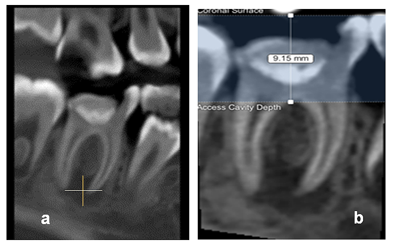 Figura 3. a). Corte tomográfico (Fov 5X5) del diente 4.6, b) Imagen analizada en software 3D Endo donde se observa la presencia de lesión periapical.
