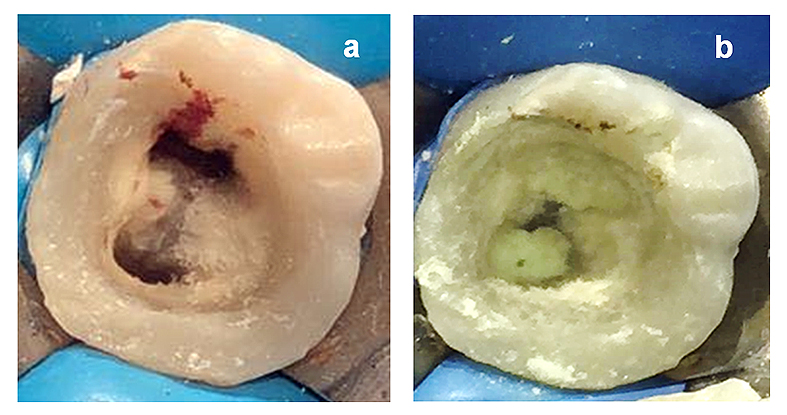 Figura 6. a). Inducción del sangrado de los canales mesiales. b). Colocación de MTA en la entrada de los canales radiculares.