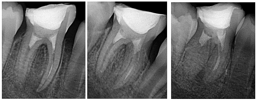 Figura 7. Tomas radiográficas orto, mesio y disto-radial, donde se confirma la colocación del MTA así como la extrusión del material dentro del canal mesio-bucal.