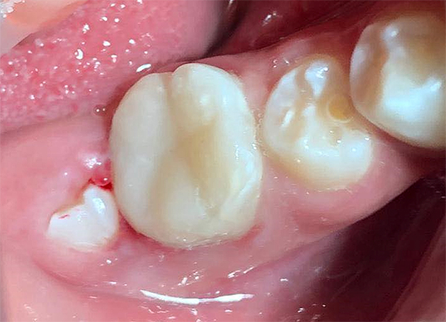 Figura 8. Restauración de composite en el diente 4.6