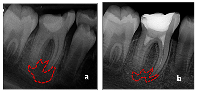 Figura 9. a) Radiografía inicial. b) Radiografía a 3 meses de seguimiento (reducción de la radiolucencia periapical).