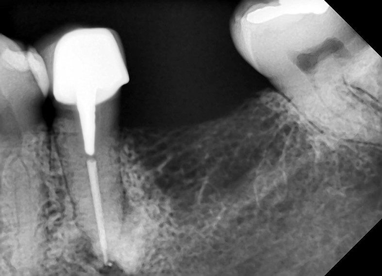 Figura 2. Radiografía periapical inicial del diente 3.5