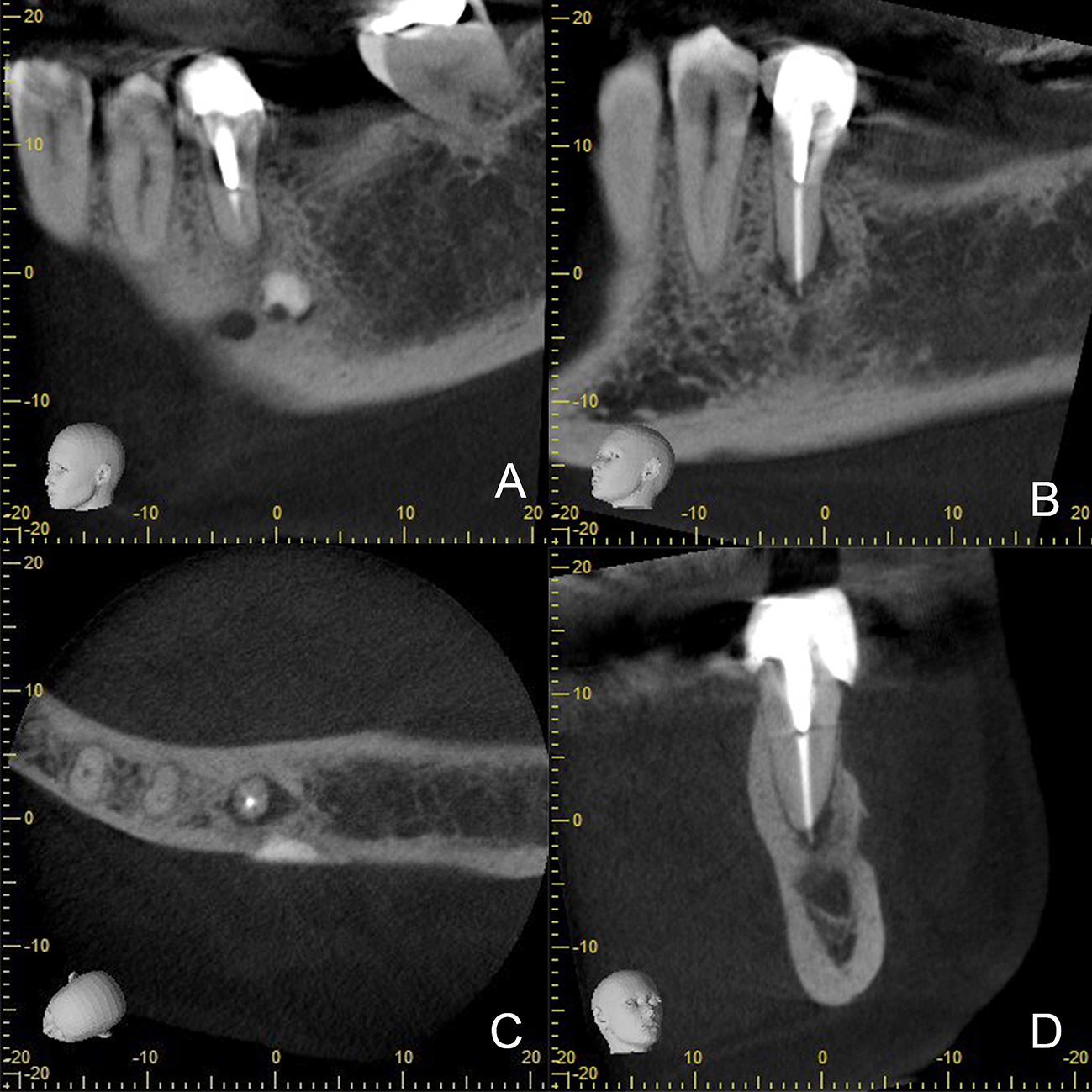 Figura 3. CBCT prequirúrgica del diente 3.5 A. Vista sagital de la superficie bucal que evidencia presencia de material hiperdenso cerca al foramen mentoniano. B. Vista sagital que evidencia lesión peri radiculra del diente 3.5 sin apicectomía previa. C. Vista axial en la se observa la cecanía del material hiperdenso con el ápice radicular del diente 3.5 D. Vista coronal del diente 3.5.