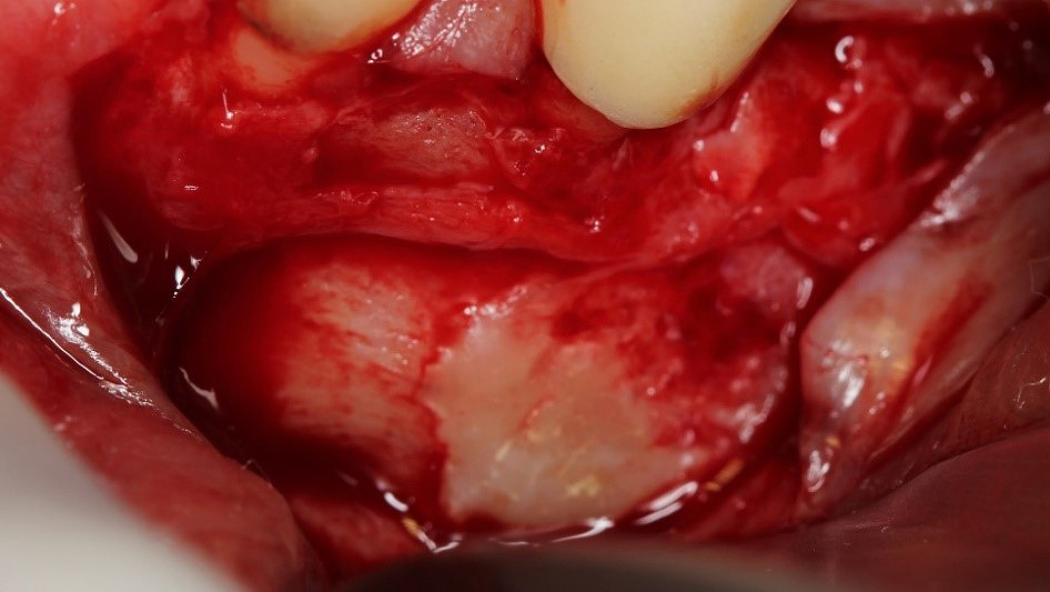 Figura 5. Material exógeno adherido a la cortical bucal cerca de la zona apical del diente 3.5 y el foramen mentoniano.