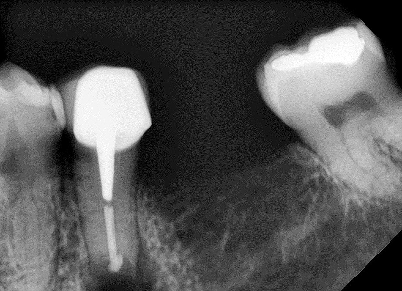 Figura 8. Aspecto radiográfico de la obturación de la cavidad apical con MTA