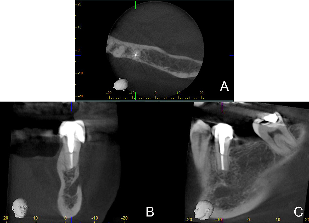 Figura 9. CBCT 1,5 años posquirúrgicos en la que se evidencia cicatrización completa de los tejidos óseo peri-radiculares del diente 3.5 en la vista axial (A), coronal (B) y sagital (C).