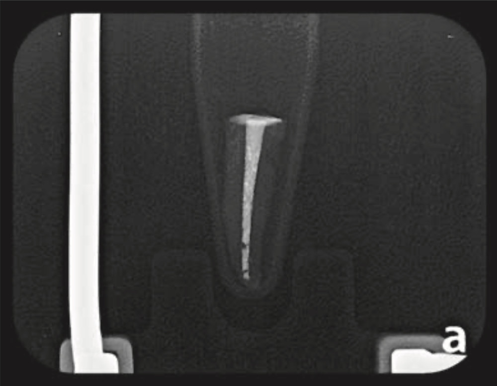 Figura 3b. Radiografía de canal radicular posterior al uso de Xp-endoFinisher®