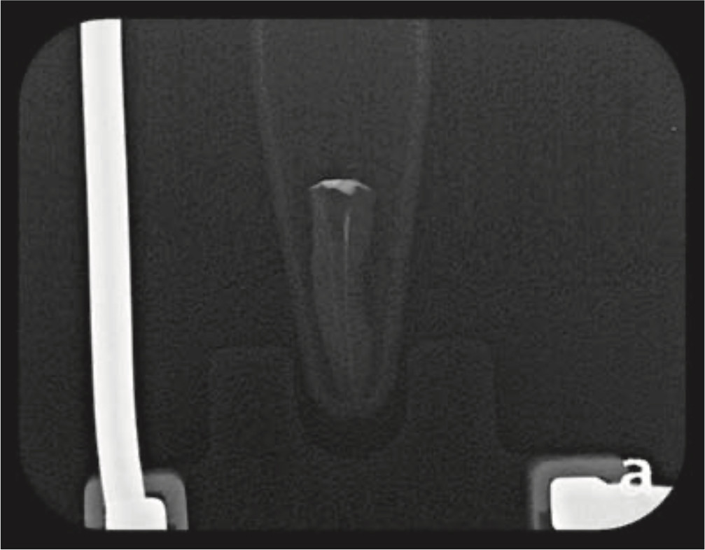 Figura 4b. Radiografía de canal radicular posterior al uso de ultrasonido