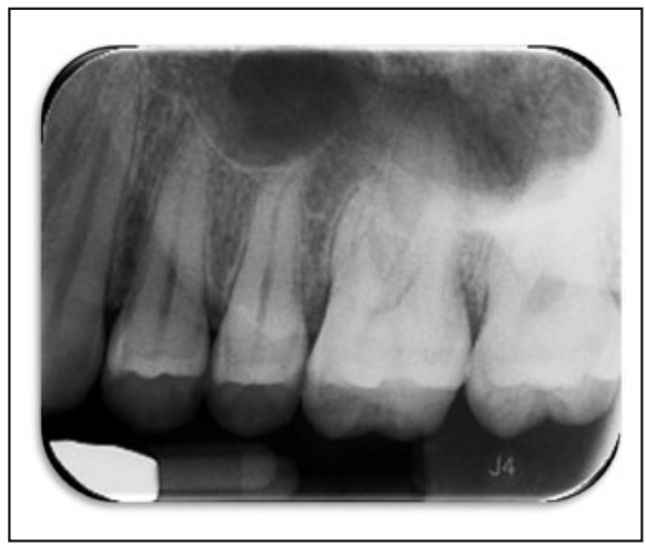 Figura 1. Radiografía retroalveolar inicial