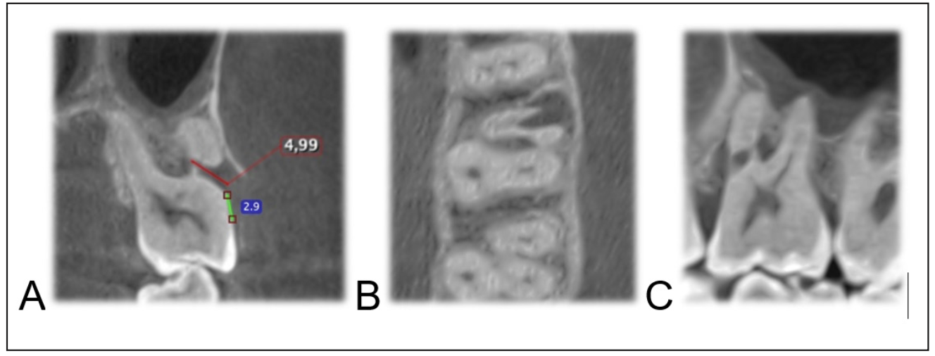 Figura 2. TCHC inicial; A) Corte coronal; B) Corte Axial; C) Corte Sagital