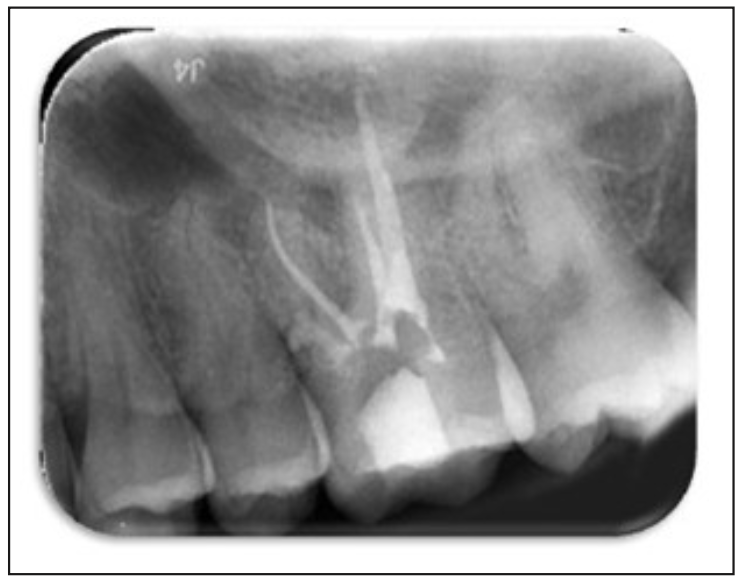 Figura 3. Radiografía retroalveolar post fase 1