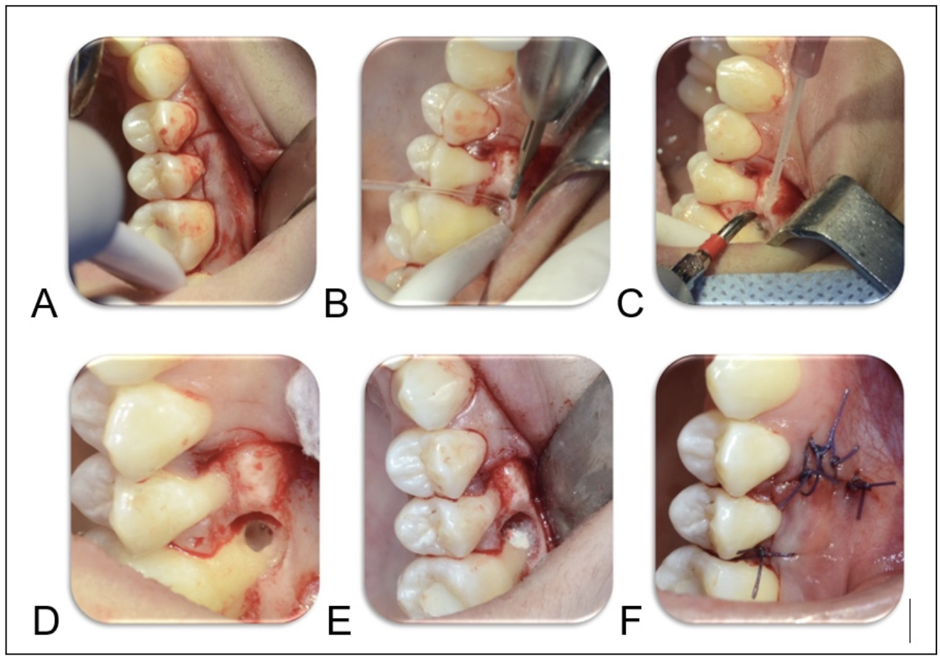 Figura 4. Microcirugía endodóntica; A) Colgajo. B) Osteotomía. C) Curetaje y limpieza de la perforación. D) Perforación limpia y seca. E) Sellado de la perforación. F) Sutura.
