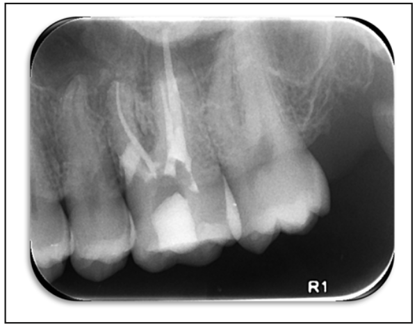 Figura 5. Radiografía retroalveolar post fase 2