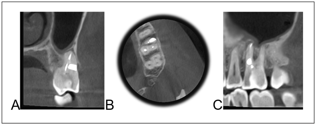 Figura 7. TCHC al finalizar el tratamiento; A) Corte Coronal; B) Corte Axial; C) Corte Sagital.