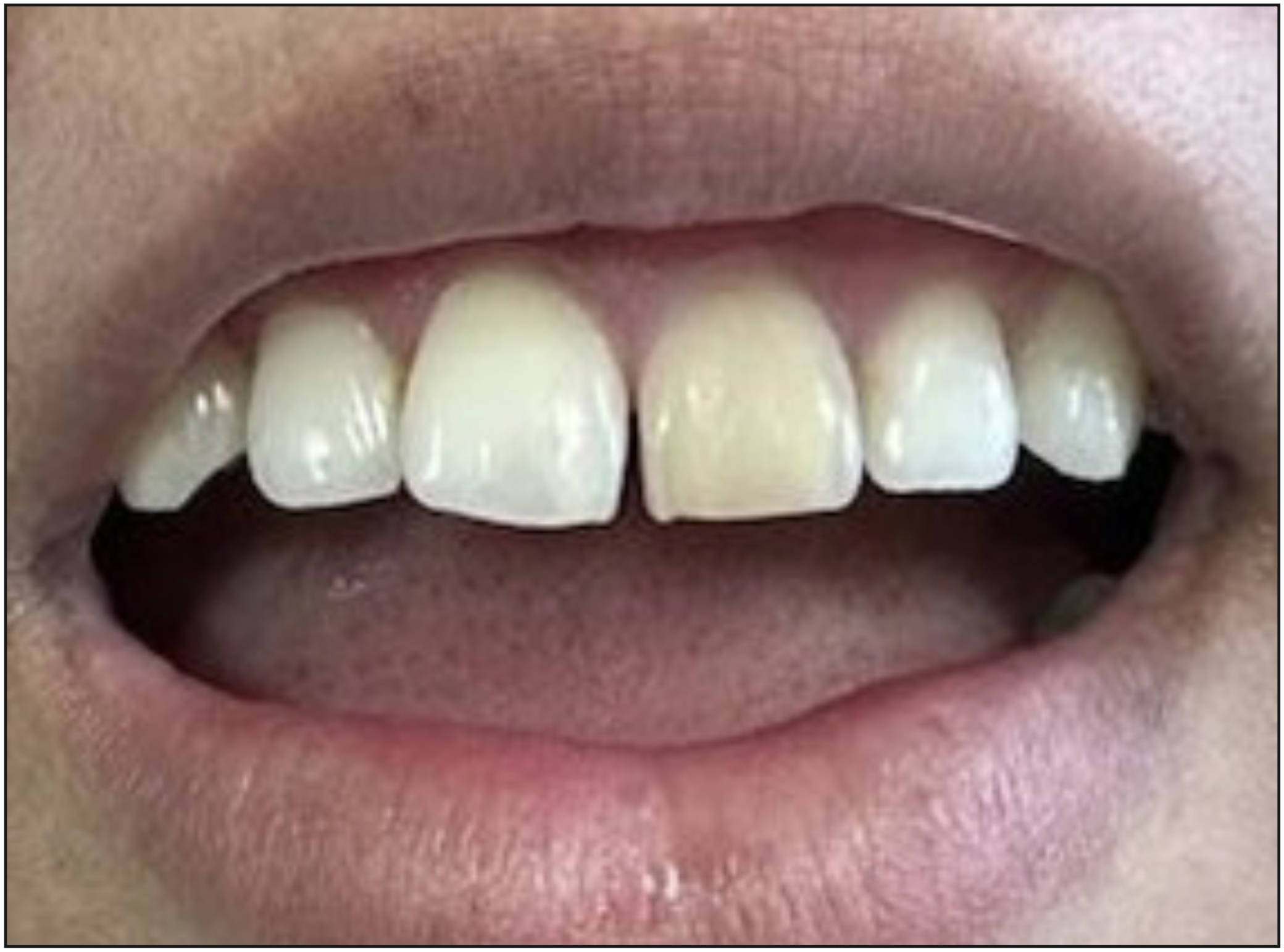 Figura 1. Fotografía diente 2.1 con cambio de coloración dentaria.