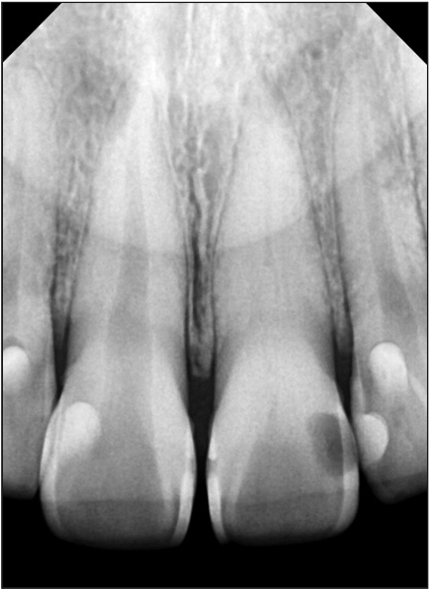 Figura 2. Radiografía diagnóstico para evaluación de acceso guiado estático.