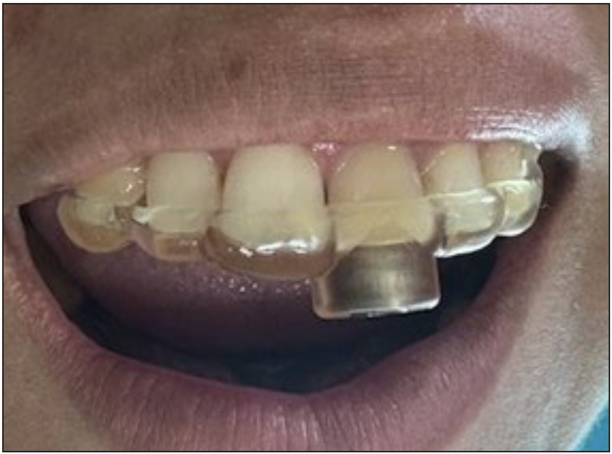 Figura 3. Prueba de guía estática para realizar el acceso guiado.