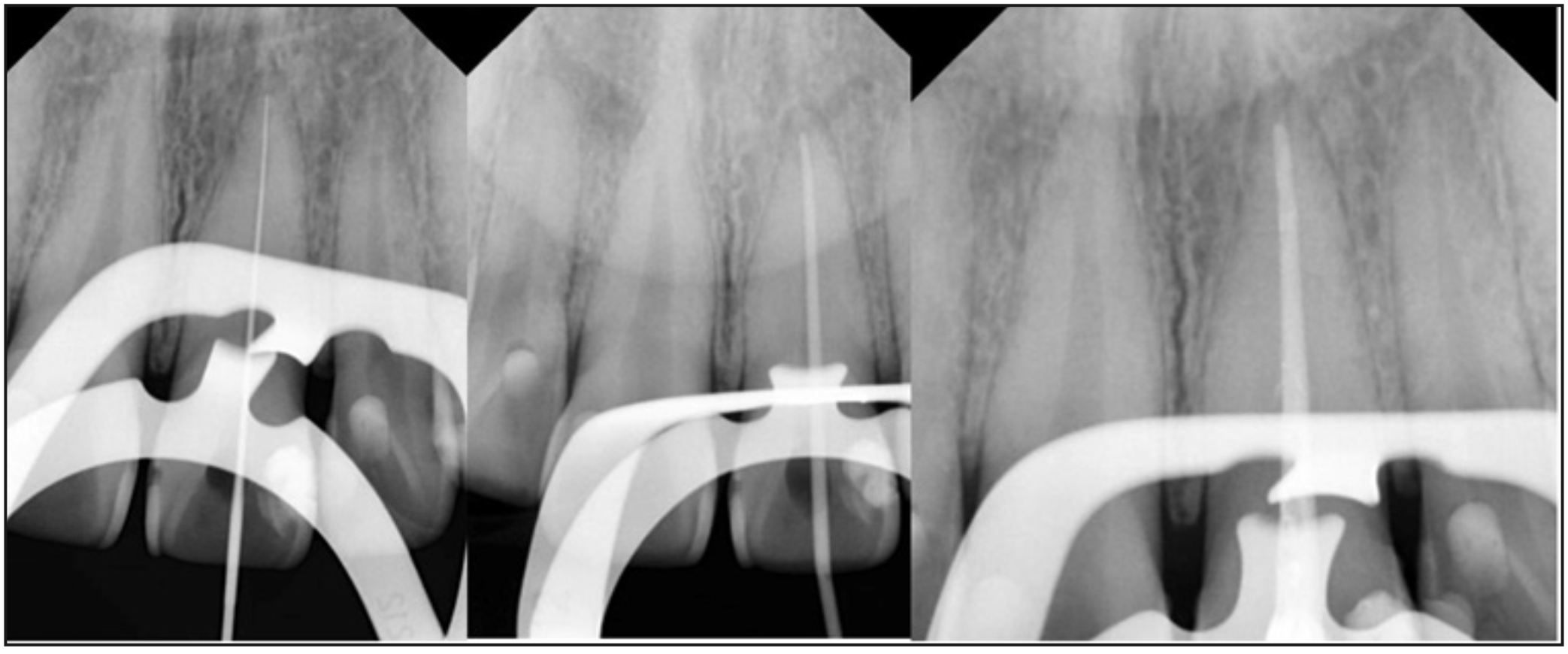 Figura 4. Conductometría, conometría y radiografía de control de obturación.