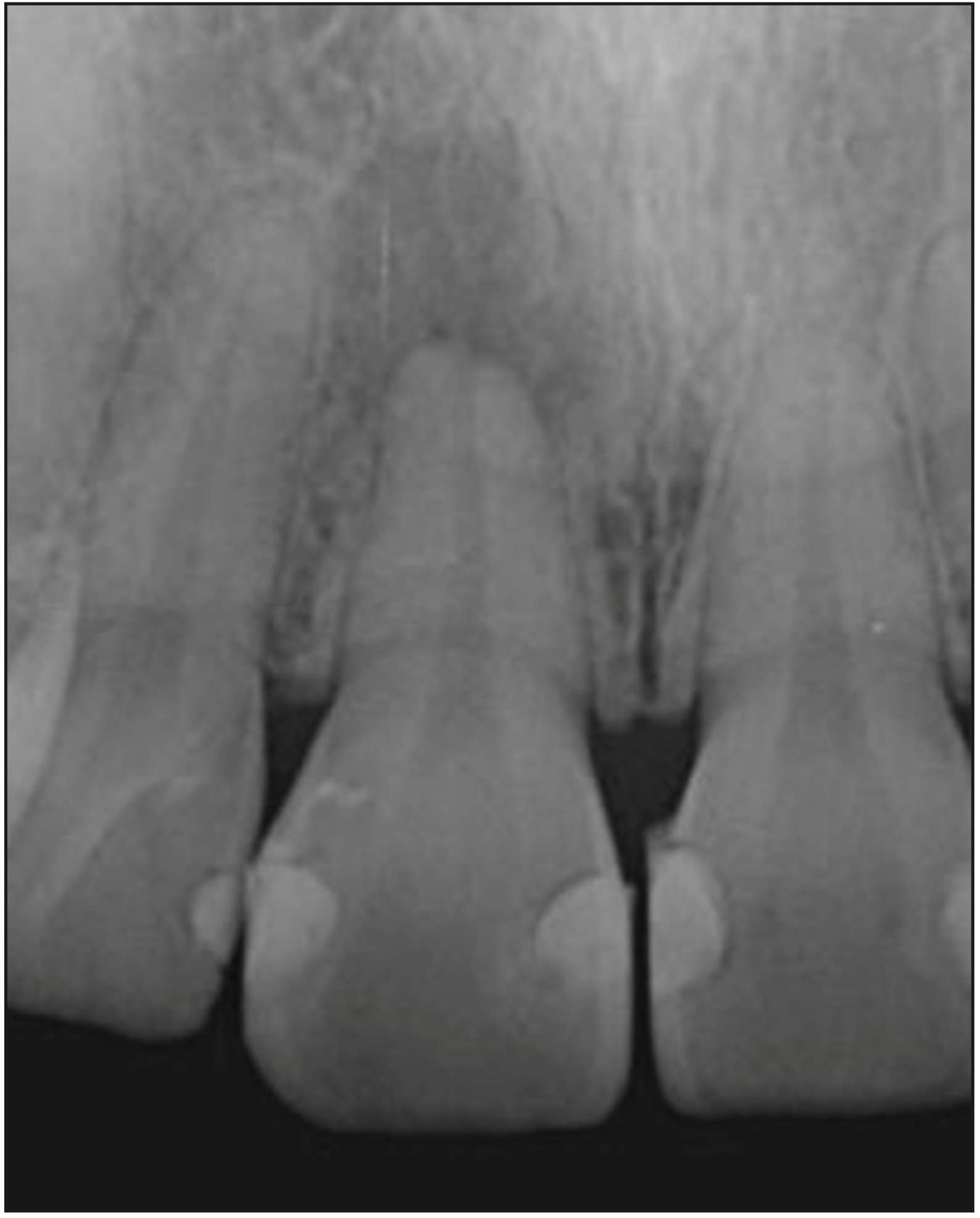 Figura 1. Radiografía retroalveolar de diagnóstico del diente 1.1. Canal radicular amplio, con remodelado. Se observa lesión osteolítica apical extensa circunscrita.