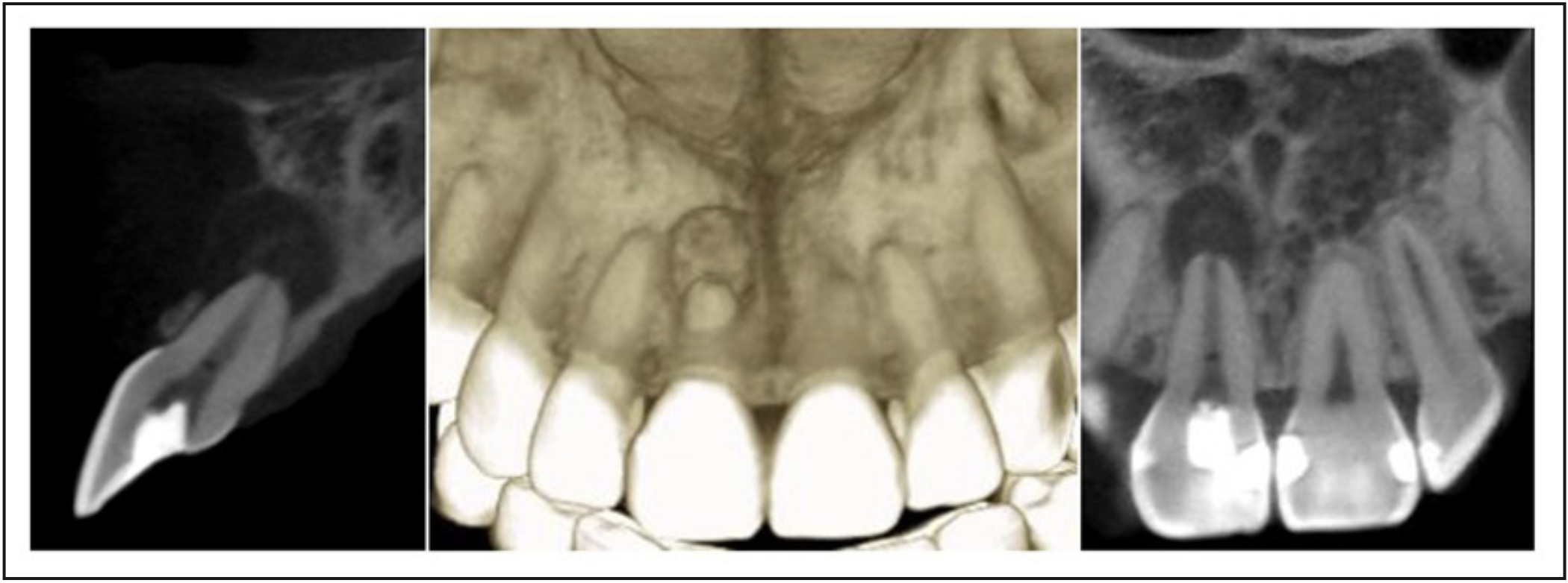 Figura 2. Tomografía computarizada de haz cónico del diente 1.1. Restauración coronaria penetrante. Canal radicular amplio con importantes signos de remodelado apical. Se observa lesión osteolítica periapical con límites netos, aparentemente corticalizada, cuyos diámetros mayores alcanzan 5,06x8,55x5,07mm. Adelgazamiento de la tabla vestibular. Trabeculado óseo heterogéneo.