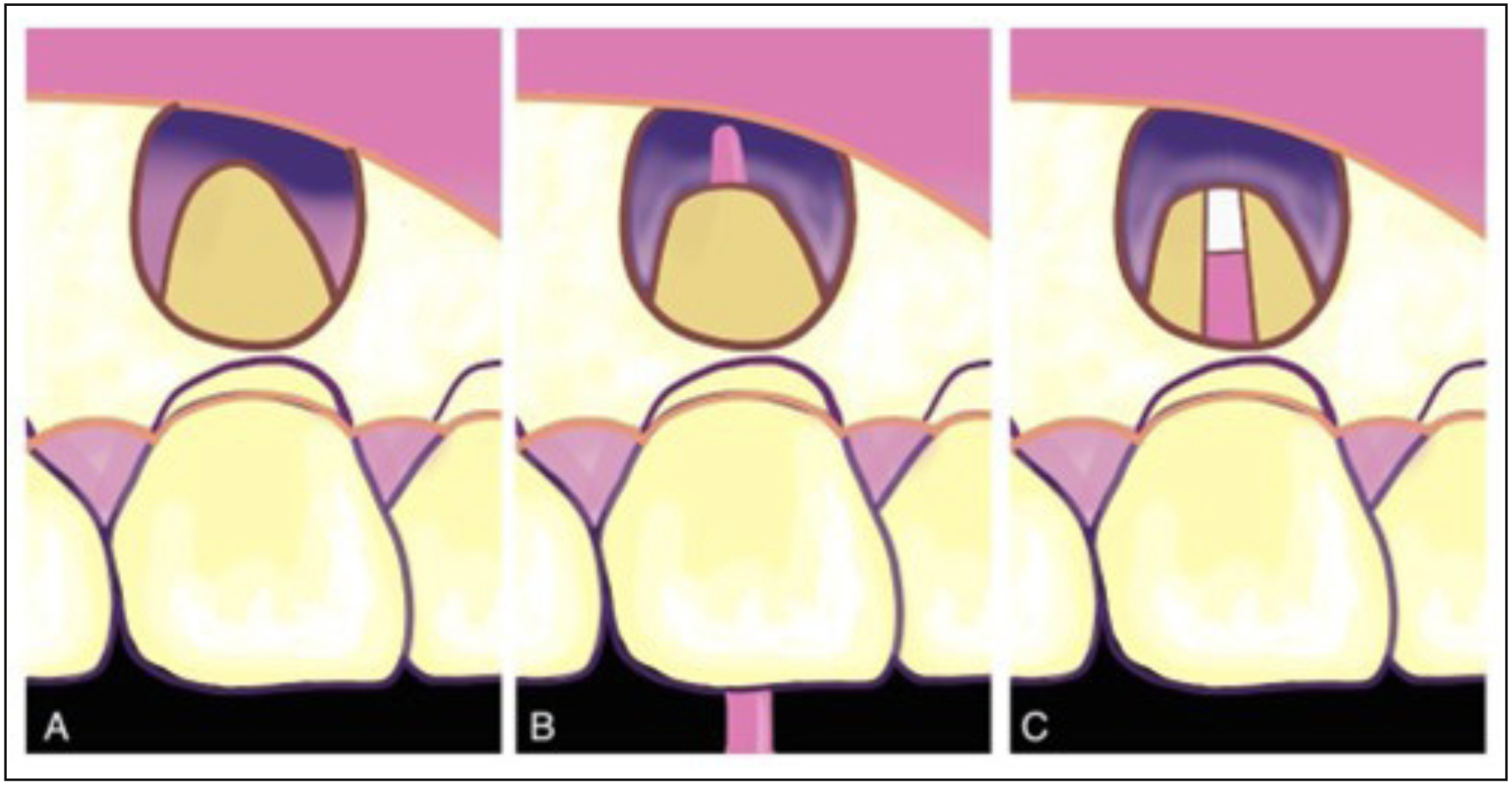 Figura 3. Esquema del procedimiento quirúrgico. A) Exposición del ápice permitiendo el desbridamiento del tejido afectado. B) Obturación intraquirúrgica con cono único y sellador biocerámico. C) Retrosellado con cemento MTA blanco tras preparación de la cavidad con ultrasonido de los 3 mm apicales.