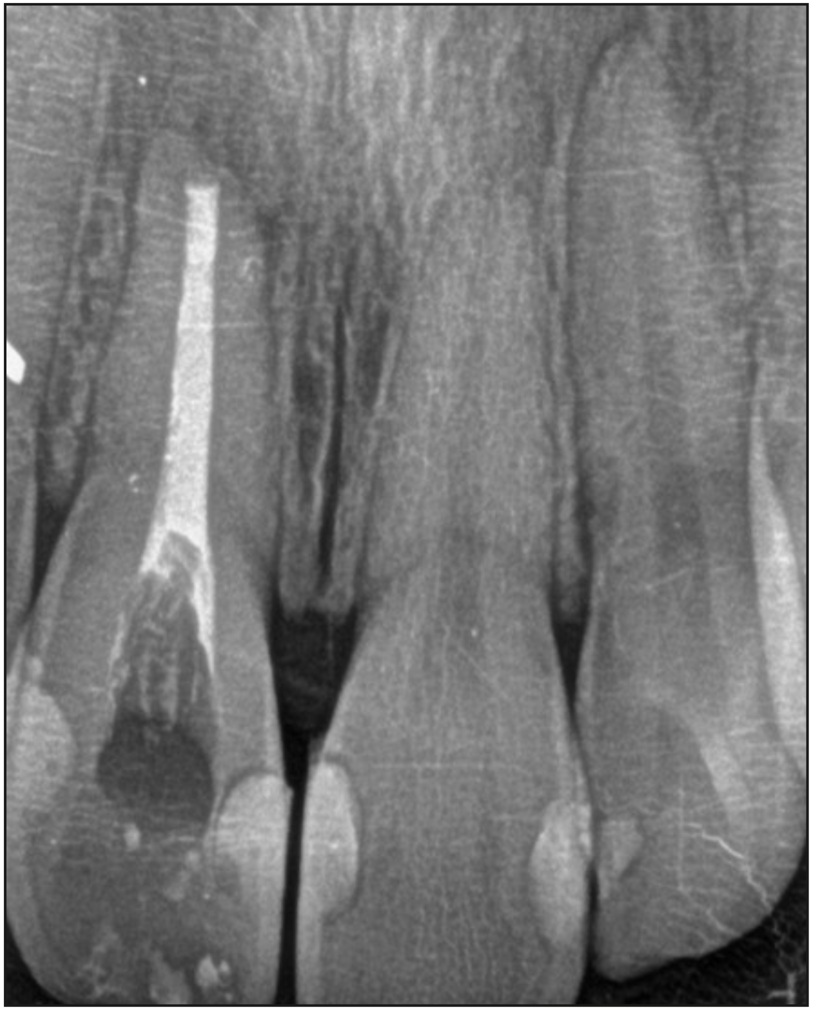 Figura 4. Radiografía de control inmediato post microcirugía y obturación endodóntica simultánea. Se observa exceso de gutapercha en zona cervical que fue corregido en sesión de control posterior.