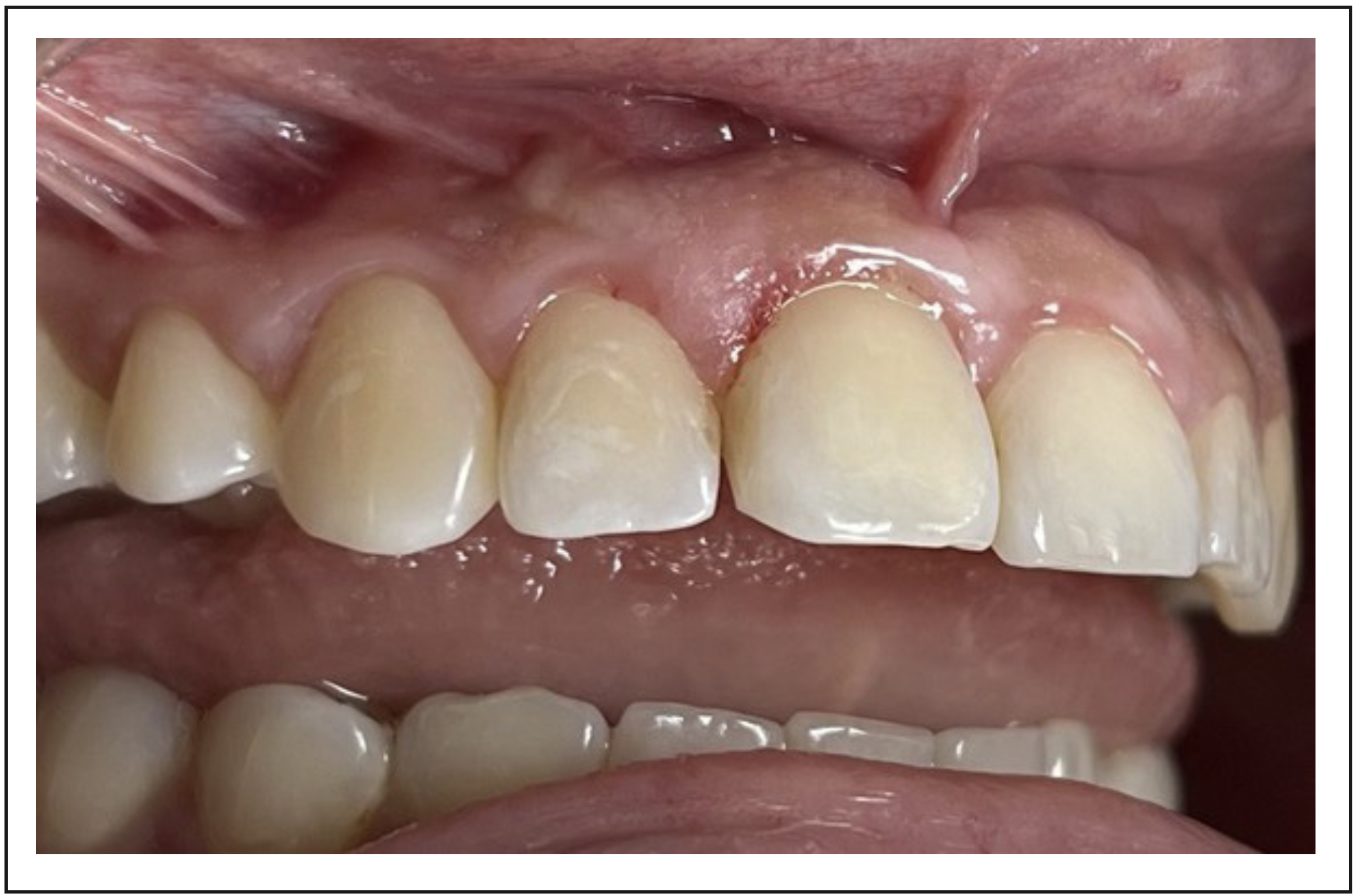 Figura 5. Control al mes posterior a la microcirugía apical donde se observa una evolución positiva respecto a la cicatrización de los tejidos. La paciente relata una mejora notable y ausencia de dolor en la zona de descarga vertical.