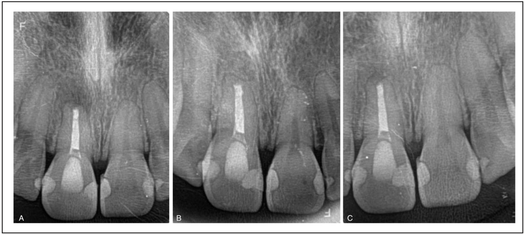 Figura 6. Control al mes posterior a la microcirugía apical donde se observa una evolución positiva respecto a la cicatrización de los tejidos. La paciente relata una mejora notable y ausencia de dolor en la zona de descarga vertical.