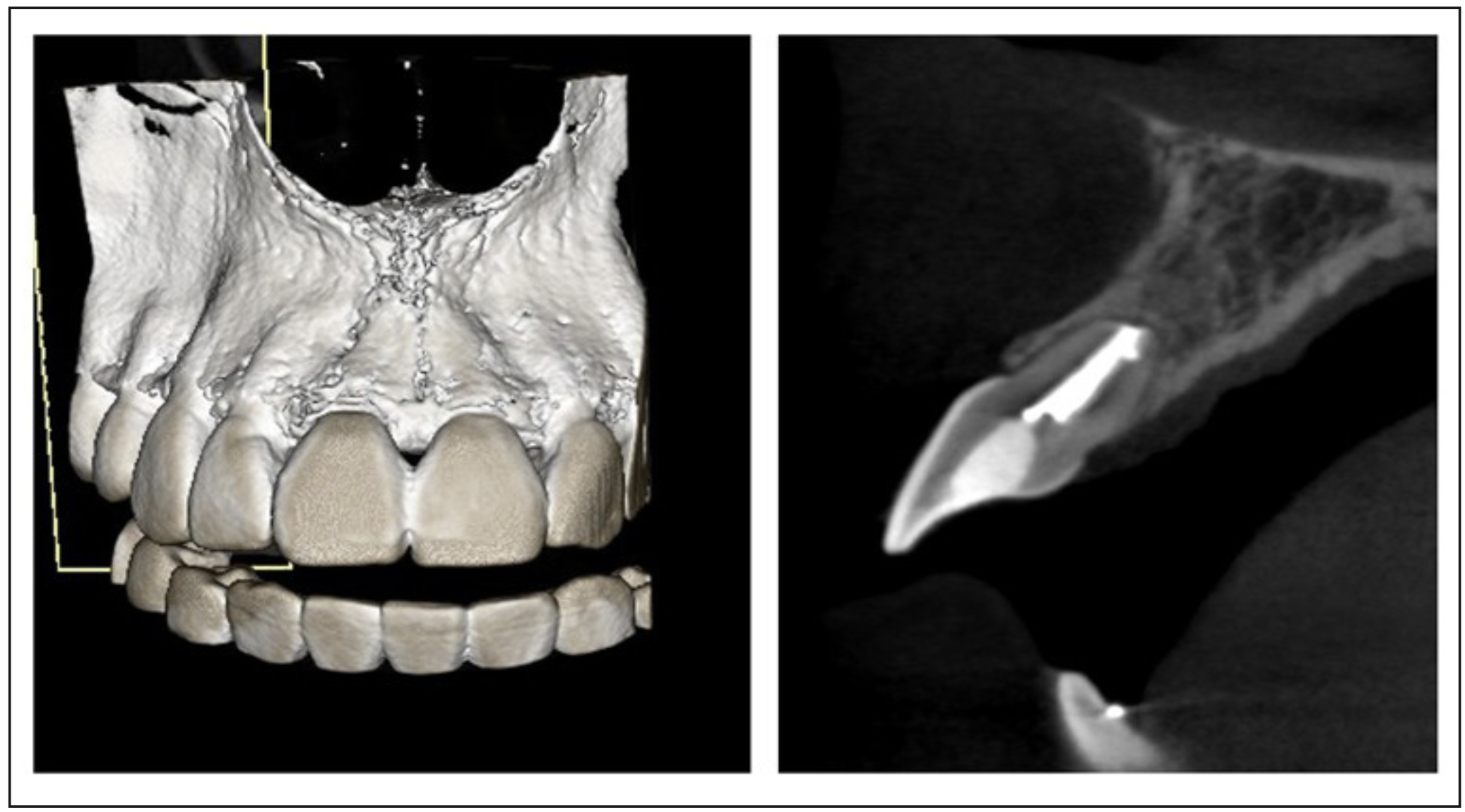 Figura 7. Tomografía de haz cónico de evolución al año post microcirugía. Se observa el relleno hiperdenso de la obturación endodóntica con signos de remodelación apical, trabeculado óseo perirradicular conservado. Tablas óseas vestibular y palatinas conservadas, con mínima interrupción de la tabla ósea vestibular.