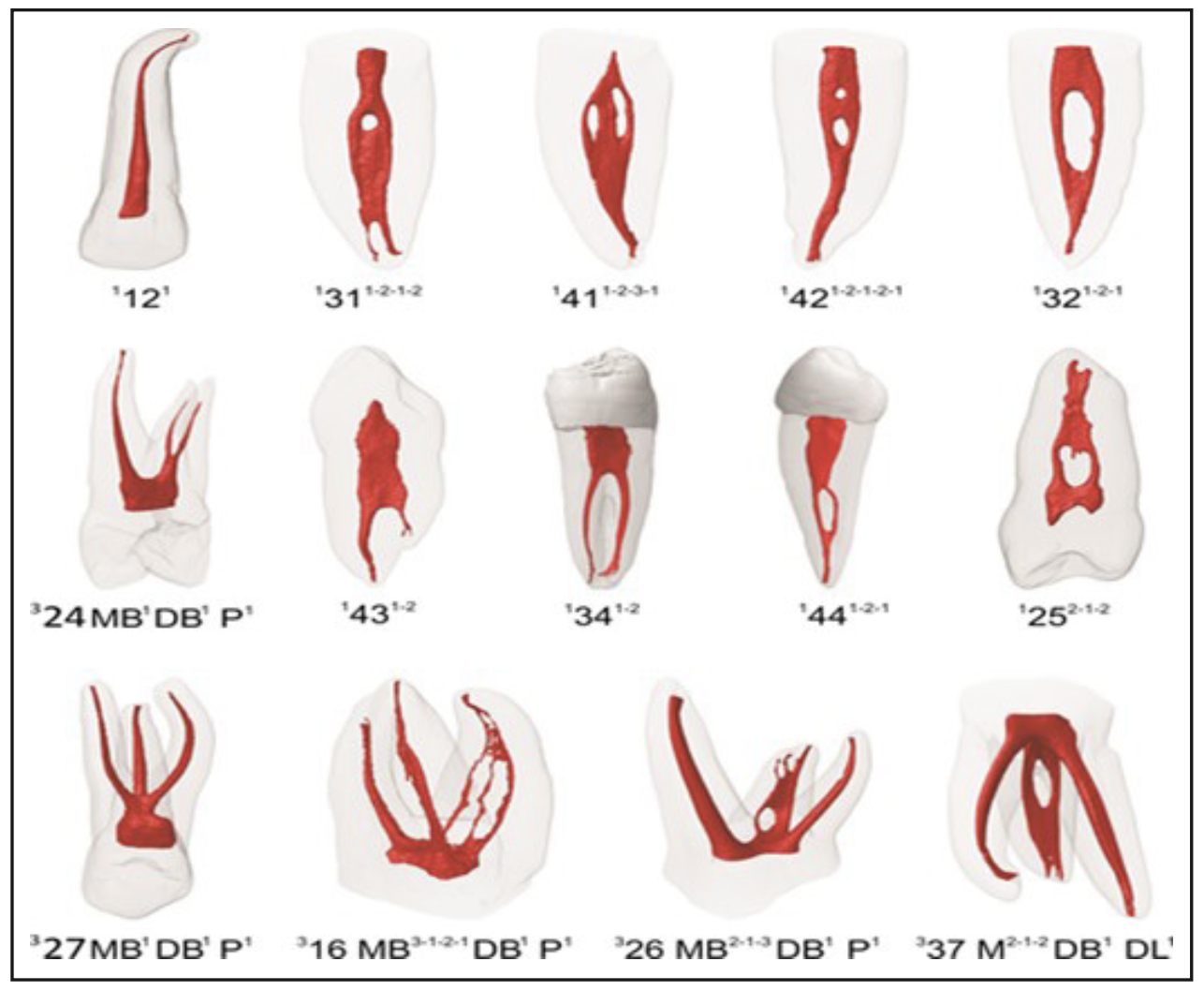 Figura 2. Modelo 3D obtenido con microCT de premolares mandibulares clasificadas según el nuevo sistema de clasificación de Ahmed.