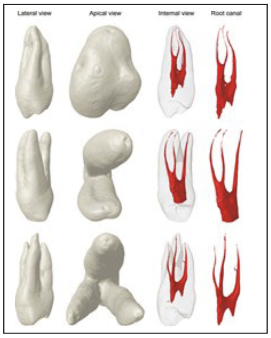 Figura 1. Vista externa e interna de 3 premolares superiores clasificados según literatura como tipo VIII de Vertucci. *Imagen tomada del artículo de Ahmed(12)