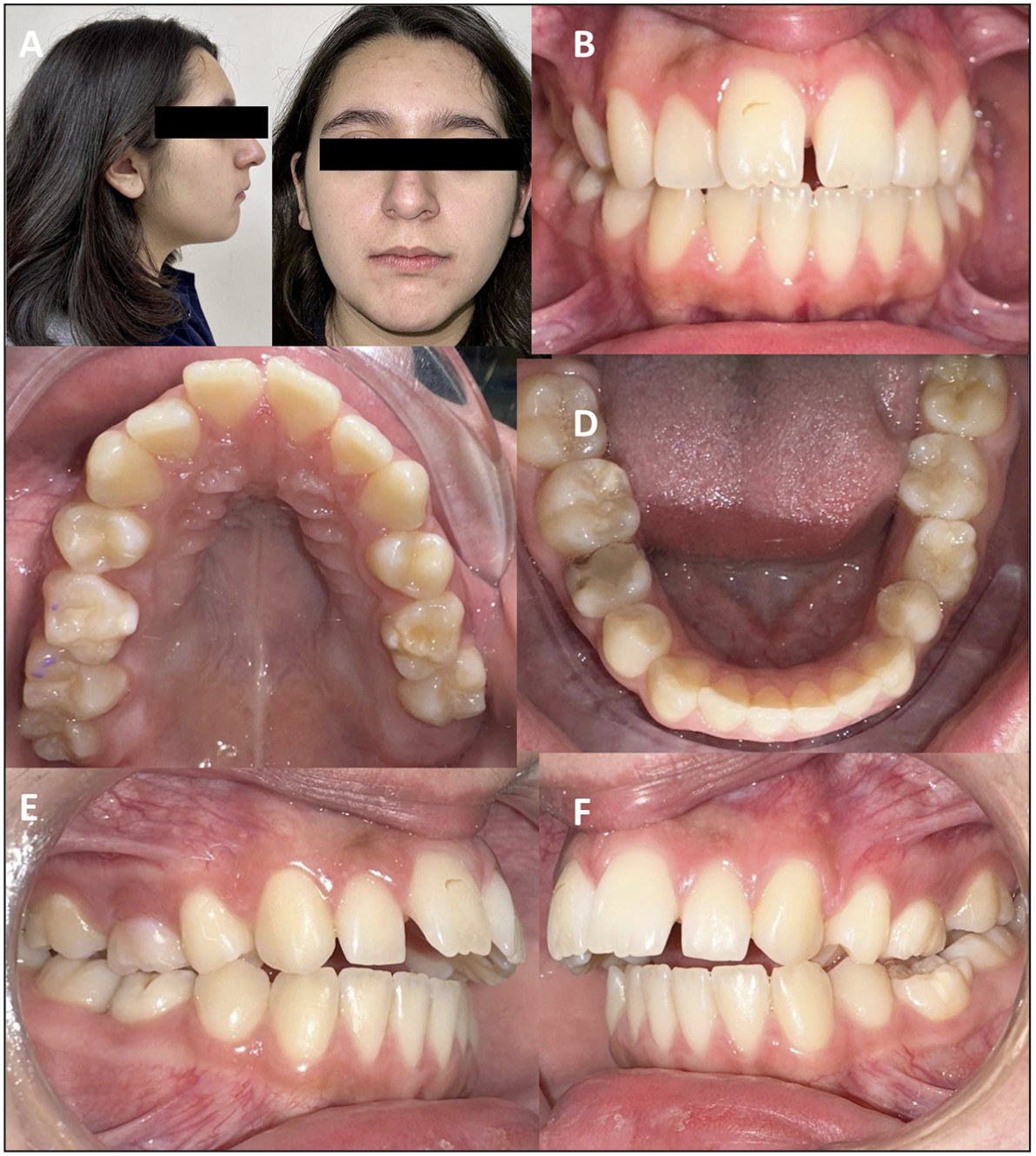 Figura 1. Fotografías clínicas extra e intraorales de la paciente. (A) perfil convexo y tercio inferior aumentado / (B) líneas medias coincidentes, dentición mixta segunda fase / (C-D) persistencia de segundos molares temporales superiores inferiores / (E-F) mordida cruzada parcial izquierda, escalón disminuido y resalte muy aumentado.