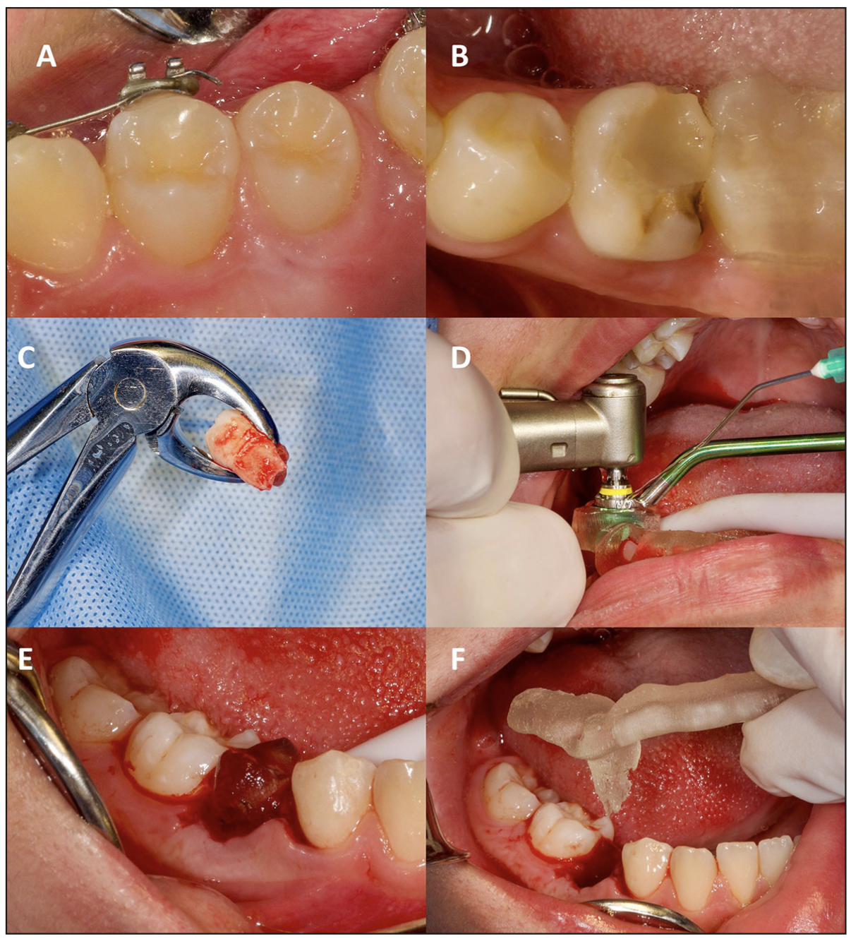 Figura 5. (A) Diente 1.5, donante / (B) Sitio del lecho receptor donde se encuentra la permanencia del diente 8.5 con agenesia del diente 4.5 / (C) Exodoncia diente 8.5 / (D) Preparación del lecho receptor / (E) Prueba del CARP model o réplica / (F) Prueba de splint con réplica.