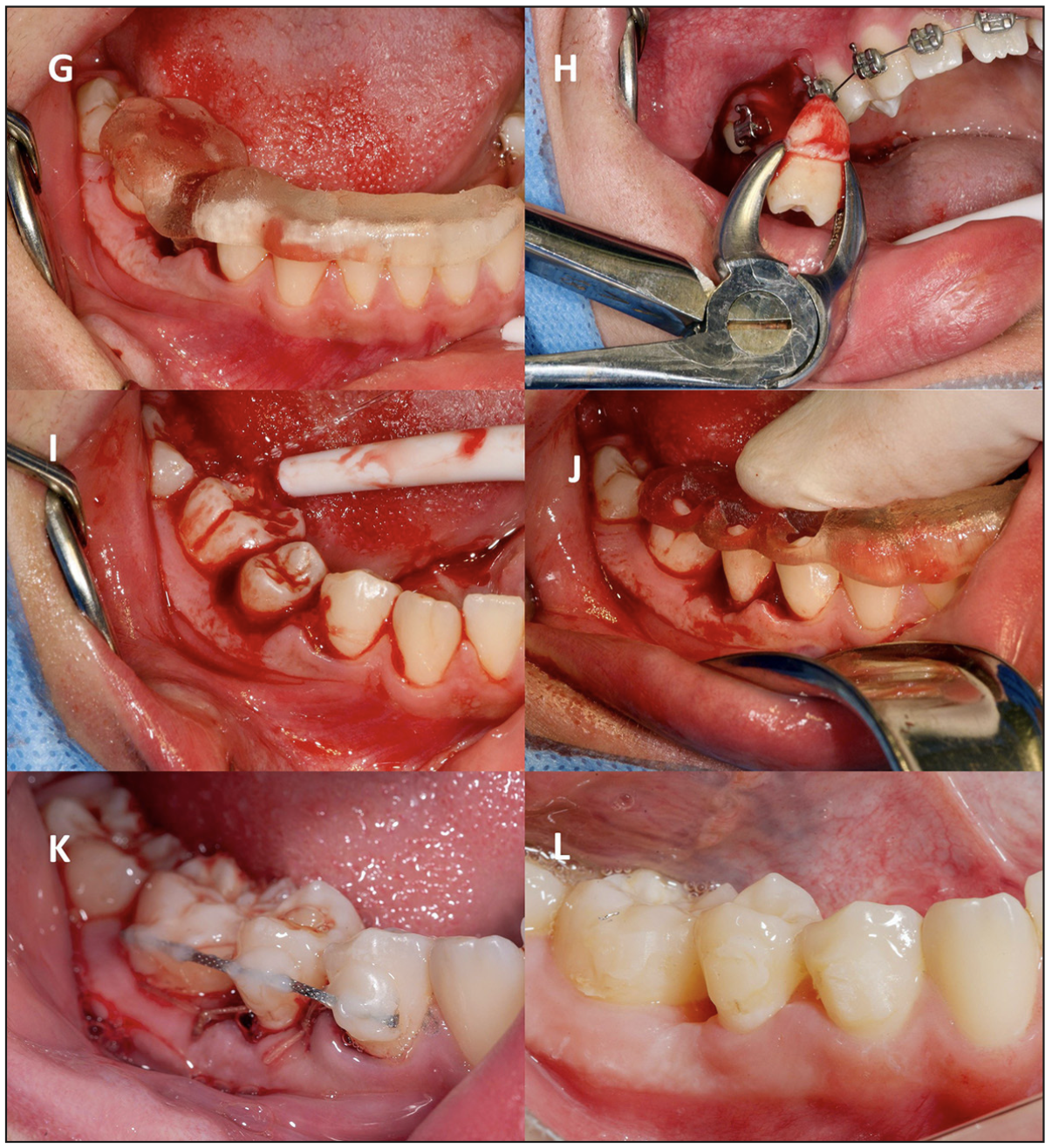 Figura 6. (G) Posicionamiento de splint con réplica / (H) Exodoncia diente 1.5 (diente donante) / (I) Reimplante de diente 1.5 en el lecho receptor / (J) Splint de estabilización del diente donante para ferulización / (K) Ferulización semi rígida con alambre trenzado 0,4 mm (L) Seguimiento clínico a las 4 semanas.