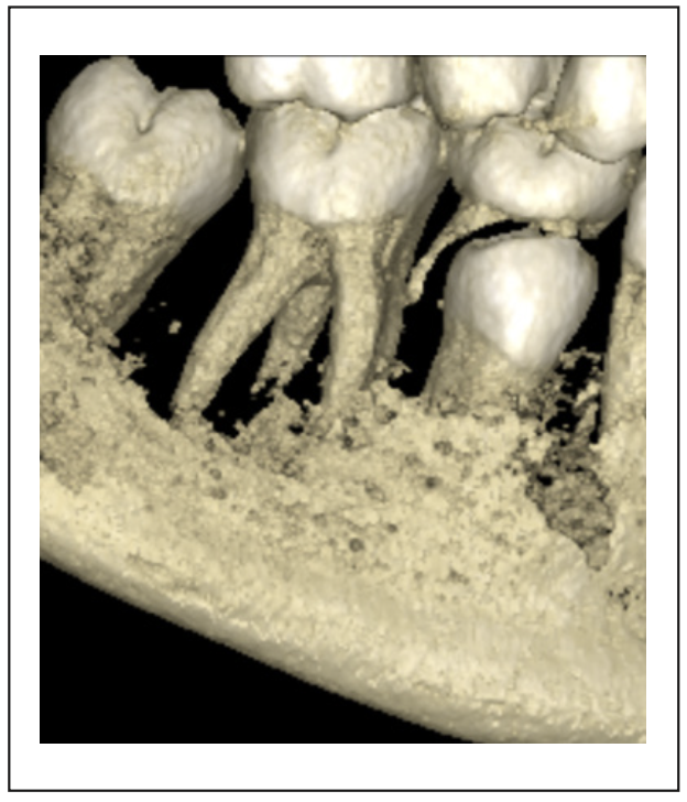 Figura 3. Tomografía Radix entomolaris