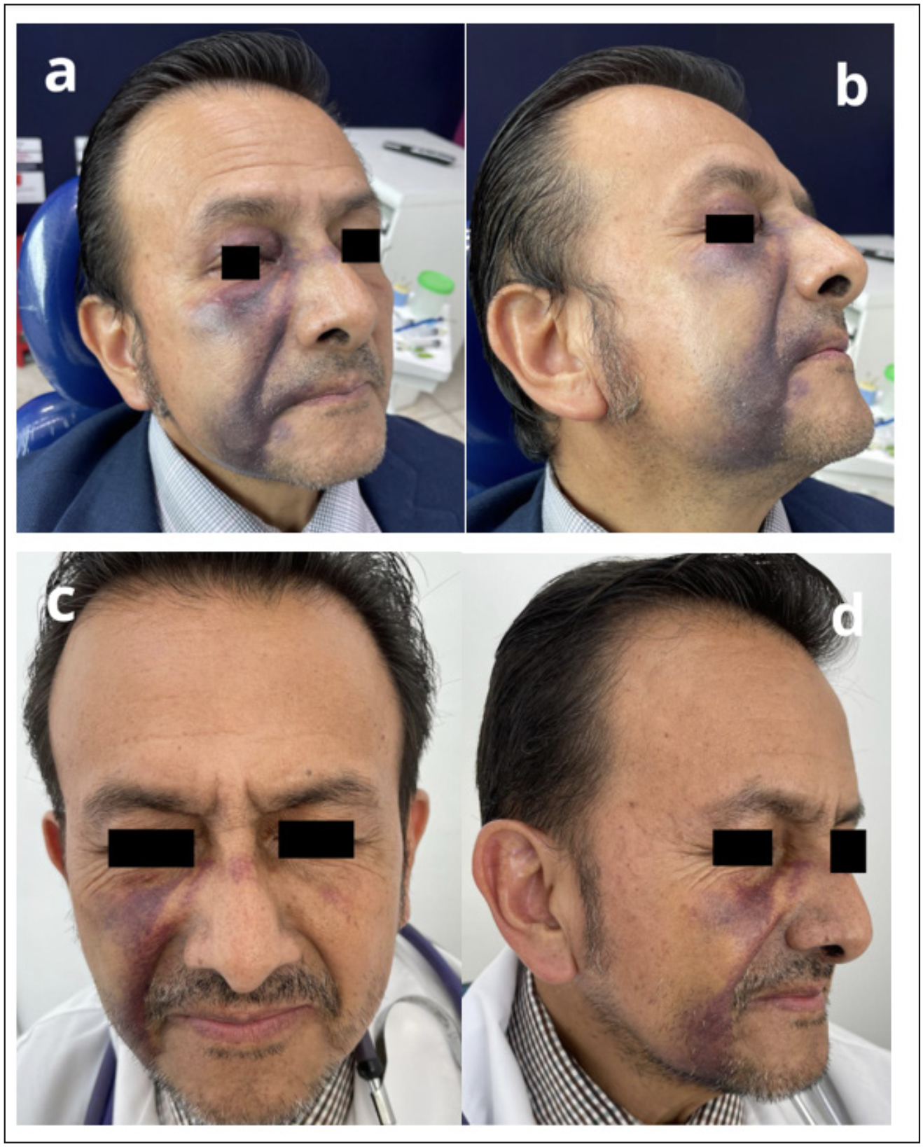 Figura 2. a y b) Control fotográfico 2 días posterior al accidente c y d) Control fotográfico 8 días posterior al accidente