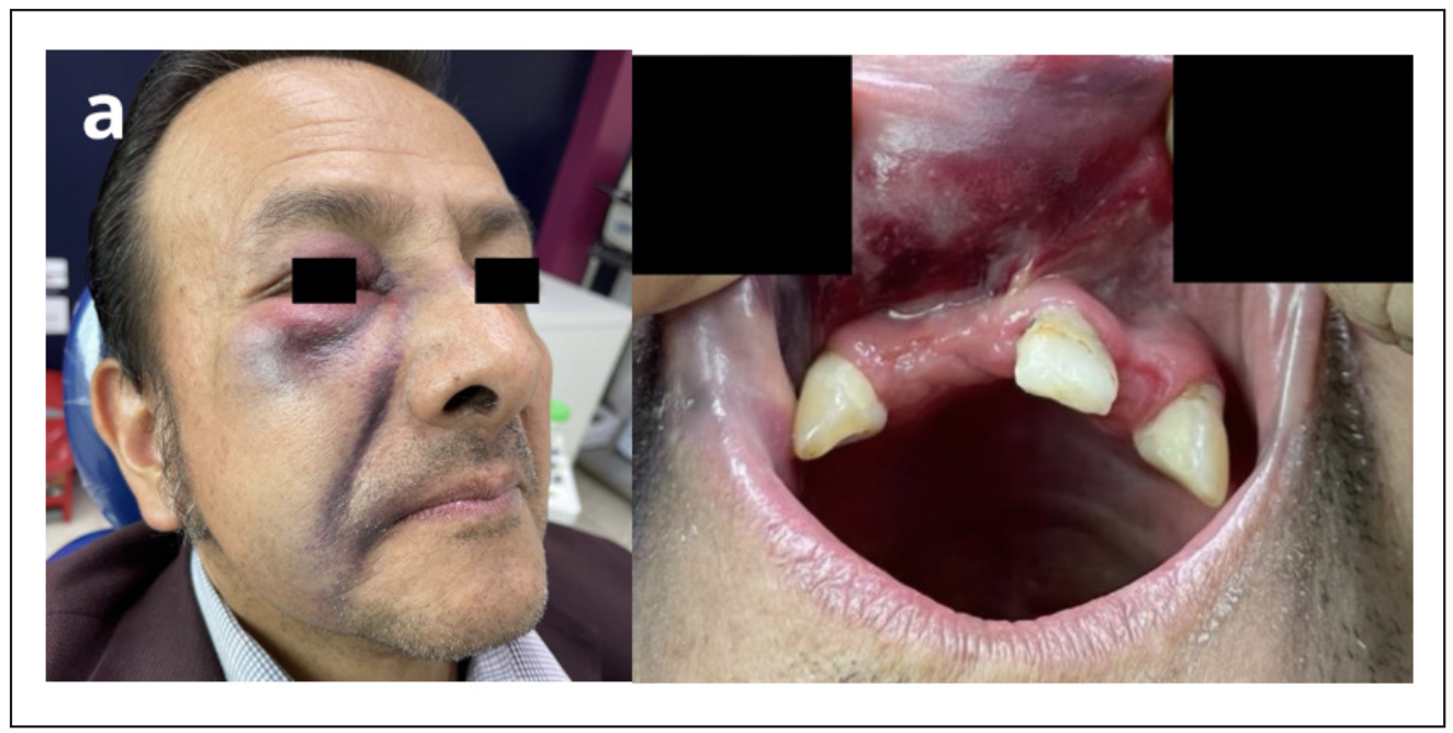 Figura 1. a) Fotografía zona infraorbitaria b) Fotografía mucosa alrededor del diente.