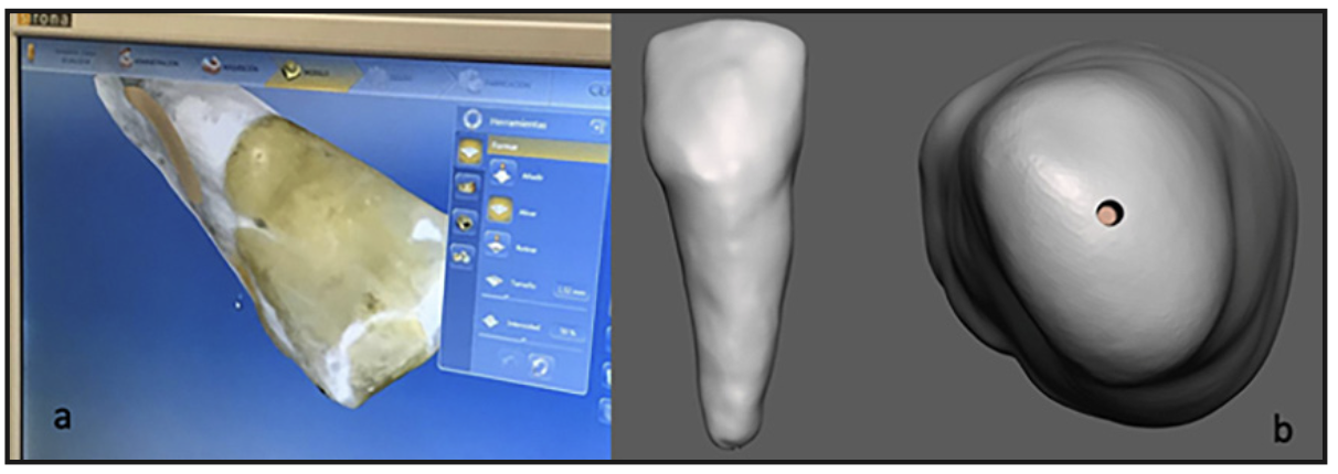 Figura 1. a) Proceso de escaneo de superficie de diente natural. b) Archivo LTE obtenido y modificado con canal en los 4 mm apicales.