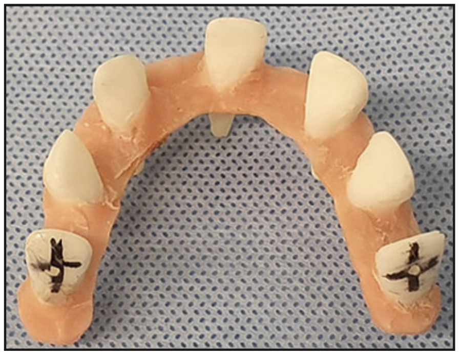 Figura 3. Dientes posicionados en arcadas, unidos en cervical con acrílico. Los dientes posteriores se agregaron para dar estabilidad a la guía.