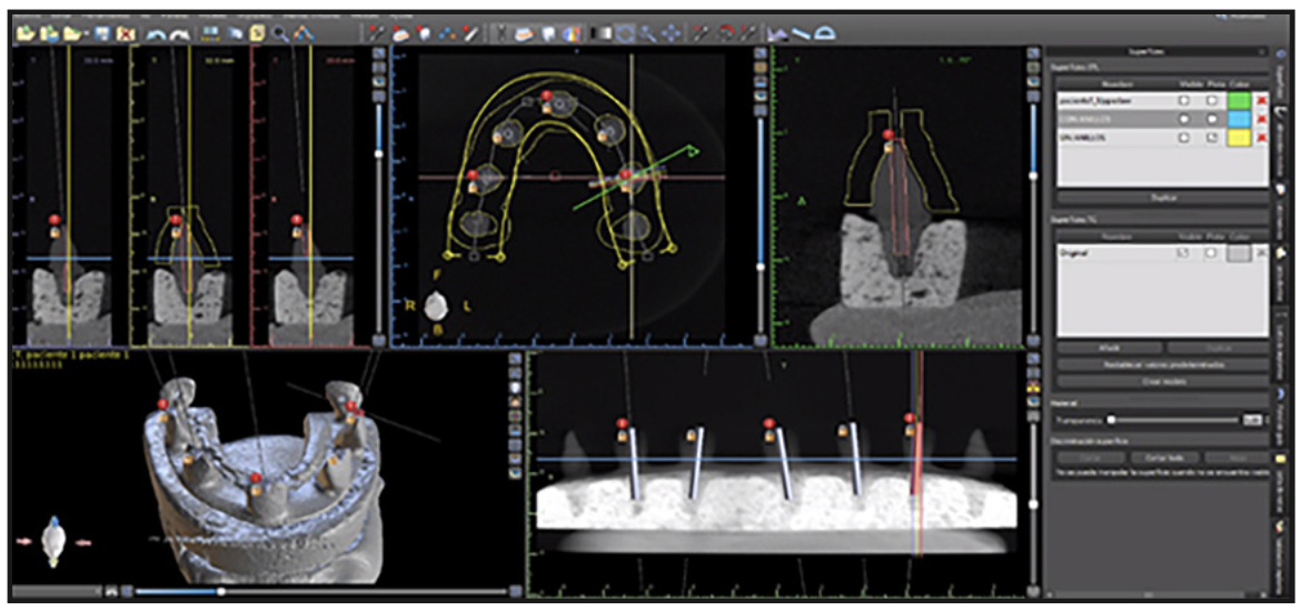 Figura 4. Proceso de planificación y diseño de las guías quirúrgicas mediante el software Blue Sky Planner®.