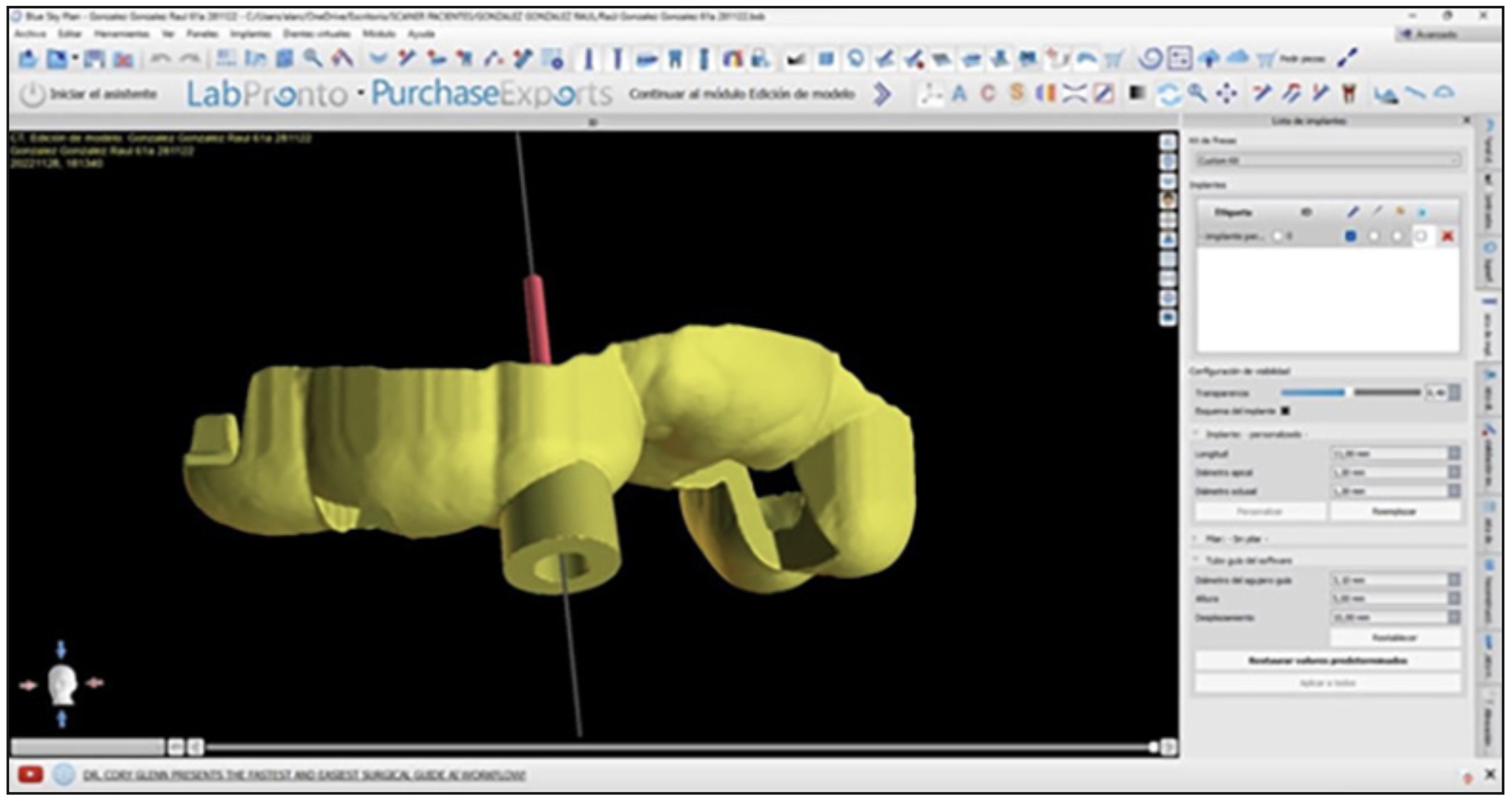 Figura 5. Diseño Guía 3D Endodóntica.
