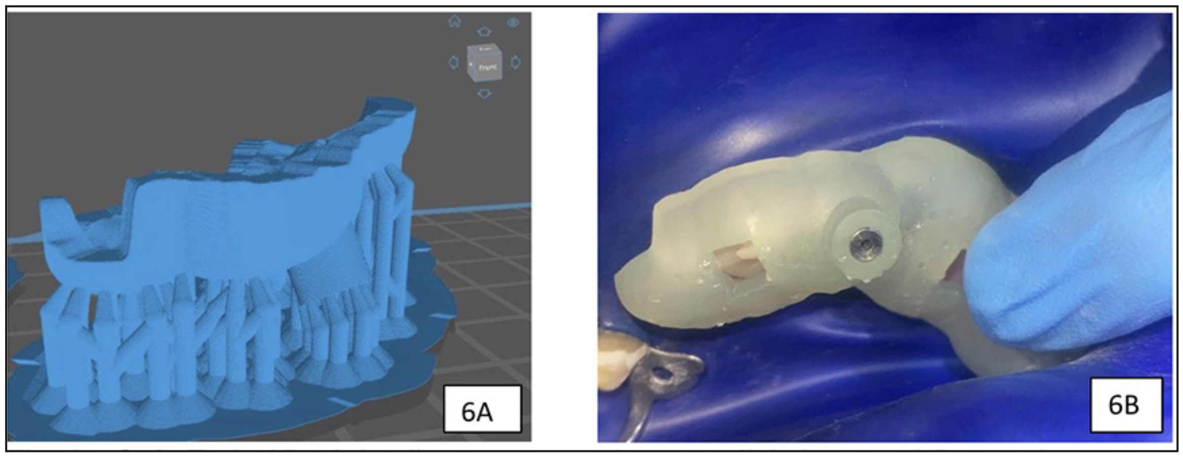 Figura 6. Guía Endo 3D. A): diseño para ser impresa digitalmente. B): prueba en boca con anillo metálico.