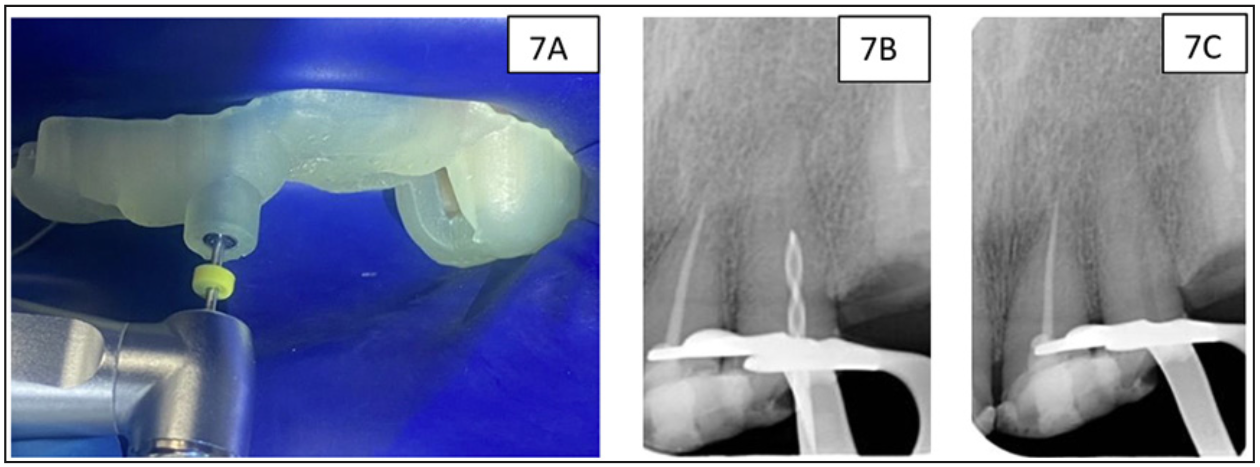 Figura 7. A): Acceso radicular con anillo y Fresa de Guía Endodóntica. B) y C): Confirmación mediante radiografía periapical.